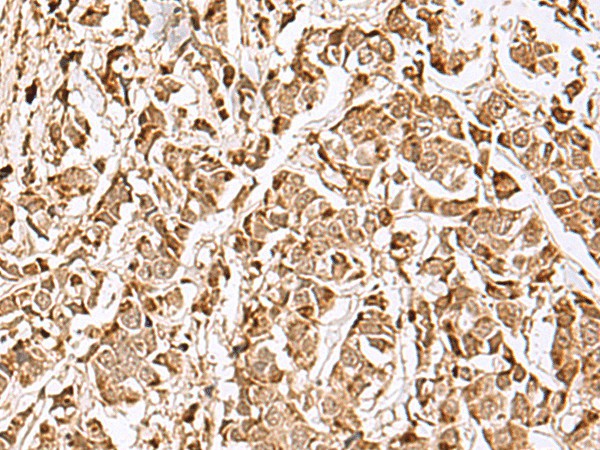 Immunohistochemistry of paraffin-embedded Human breast cancer tissue  using MECR Polyclonal Antibody at dilution of 1:70(?200)