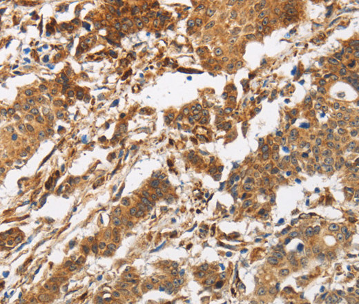 Immunohistochemistry of paraffin-embedded Human gasrtic cancer tissue using CALU Polyclonal Antibody at dilution 1:40