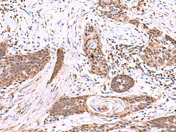 Immunohistochemistry of paraffin-embedded Human esophagus cancer tissue  using SCCPDH Polyclonal Antibody at dilution of 1:85(?200)