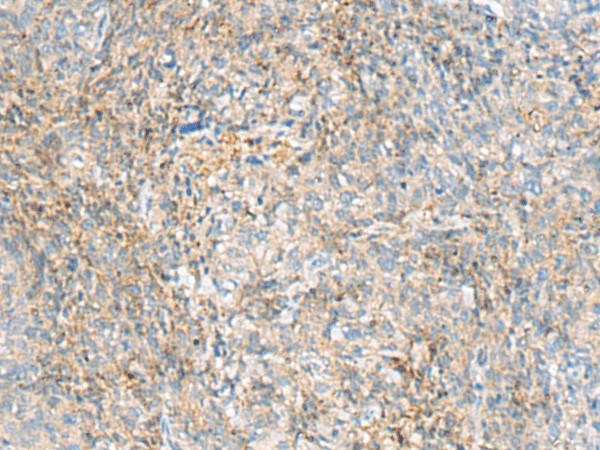 Immunohistochemistry of paraffin-embedded Human cervical cancer tissue  using HBZ Polyclonal Antibody at dilution of 1:80(?200)