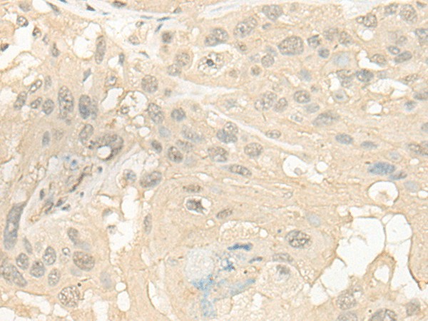 Immunohistochemistry of paraffin-embedded Human esophagus cancer tissue  using CYP4X1 Polyclonal Antibody at dilution of 1:40(?200)