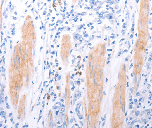 Immunohistochemistry of paraffin-embedded Human gasrtic cancer tissue using LPAR2 Polyclonal Antibody at dilution 1:40