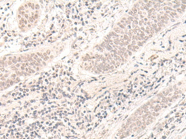 Immunohistochemistry of paraffin-embedded Human esophagus cancer tissue  using ZBED1 Polyclonal Antibody at dilution of 1:40(?200)