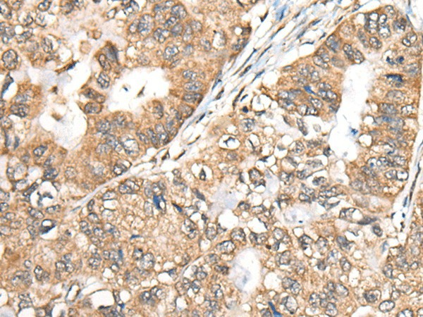 Immunohistochemistry of paraffin-embedded Human gastric cancer tissue  using BLNK Polyclonal Antibody at dilution of 1:40(?200)