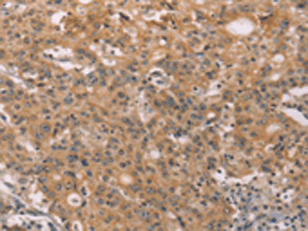 Immunohistochemistry of paraffin-embedded Human gastric cancer tissue  using ZADH2 Polyclonal Antibody at dilution of 1:51(?200)