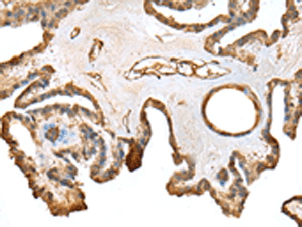 Immunohistochemistry of paraffin-embedded Human thyroid cancer tissue  using SFN Polyclonal Antibody at dilution of 1:25(?200)