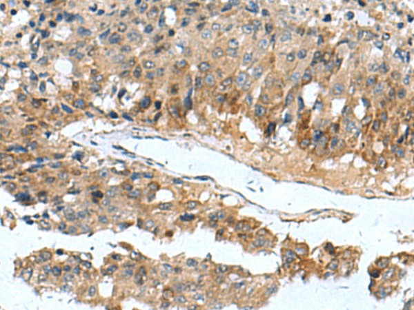 Immunohistochemistry of paraffin-embedded Human liver cancer tissue  using PDCD5 Polyclonal Antibody at dilution of 1:105(?200)