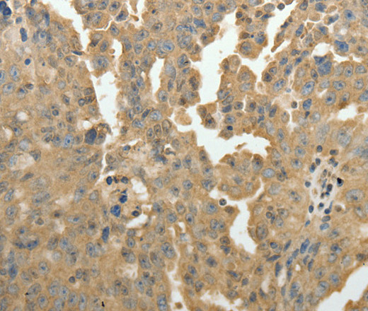 Immunohistochemistry of paraffin-embedded Human ovarian cancer using PSMD9 Polyclonal Antibody at dilution of 1:50