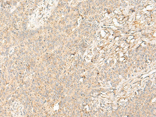 Immunohistochemistry of paraffin-embedded Human ovarian cancer tissue  using PTGDR2 Polyclonal Antibody at dilution of 1:30(?200)