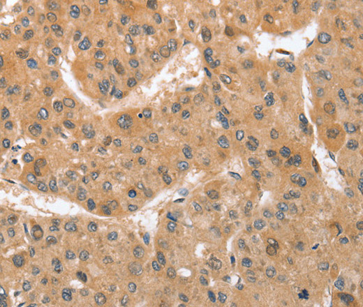 Immunohistochemistry of paraffin-embedded Human liver cancer tissue using ATG12 Polyclonal Antibody at dilution 1:70