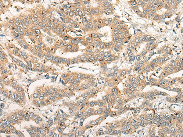 Immunohistochemistry of paraffin-embedded Human liver cancer tissue  using CPNE4 Polyclonal Antibody at dilution of 1:40(?200)