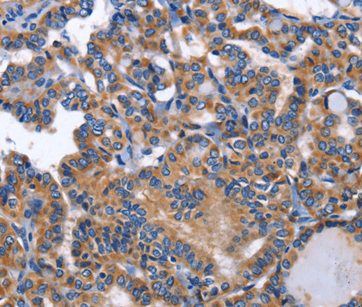 Immunohistochemistry of paraffin-embedded Human thyroid cancer using INHBC Polyclonal Antibody at dilution of 1:50