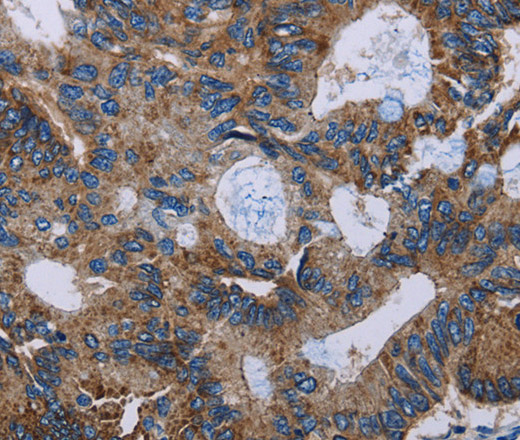 Immunohistochemistry of paraffin-embedded Human colon cancer using JAM-A Polyclonal Antibody at dilution of 1:60