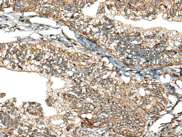 Immunohistochemistry of paraffin-embedded Human gastric cancer tissue  using CALHM1 Polyclonal Antibody at dilution of 1:40(?200)