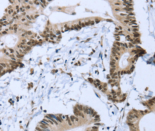 Immunohistochemistry of paraffin-embedded Human colon cancer tissue using ZMAT3 Polyclonal Antibody at dilution 1:30