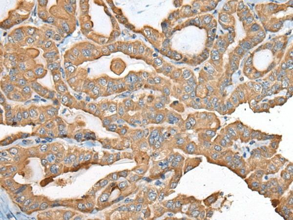 Immunohistochemistry of paraffin-embedded Human thyroid cancer tissue  using USP12 Polyclonal Antibody at dilution of 1:35(?200)