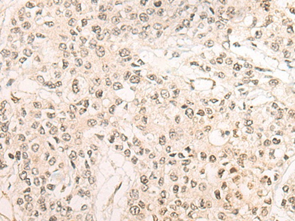 Immunohistochemistry of paraffin-embedded Human prost ate cancer tissue  using WEE1 Polyclonal Antibody at dilution of 1:35(?200)