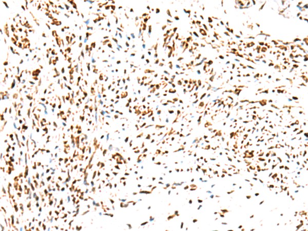 Immunohistochemistry of paraffin-embedded Human cervical cancer tissue  using KCTD13 Polyclonal Antibody at dilution of 1:50(?200)