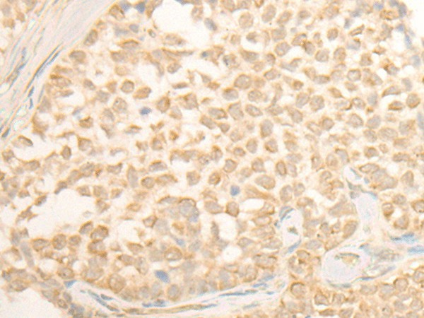 Immunohistochemistry of paraffin-embedded Human ovarian cancer tissue  using CYP4X1 Polyclonal Antibody at dilution of 1:40(?200)