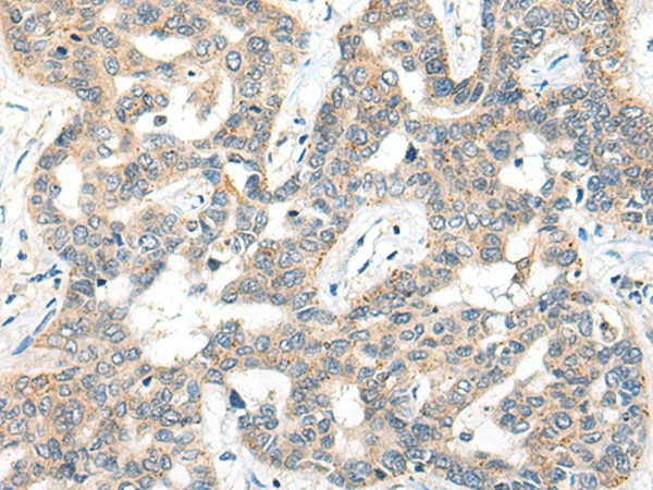 Immunohistochemistry of paraffin-embedded Human liver cancer tissue  using SNX6 Polyclonal Antibody at dilution of 1:50(?200)