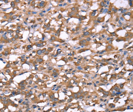 Immunohistochemistry of paraffin-embedded Human thyroid cancer tissue using SPAST Polyclonal Antibody at dilution 1:40