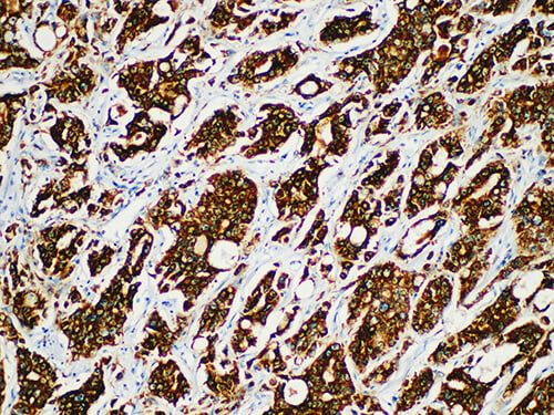 Immunohistochemistry of paraffinembedded Human prostate cancer tissue with AMACR/p504s Monoclonal Antibody(Antigen repaired by EDTA).