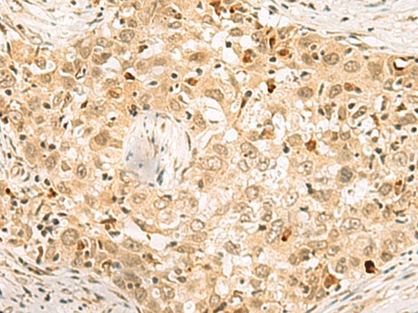 Immunohistochemistry of paraffin-embedded Human esophagus cancer tissue  using EXOSC4 Polyclonal Antibody at dilution of 1:70(?200)