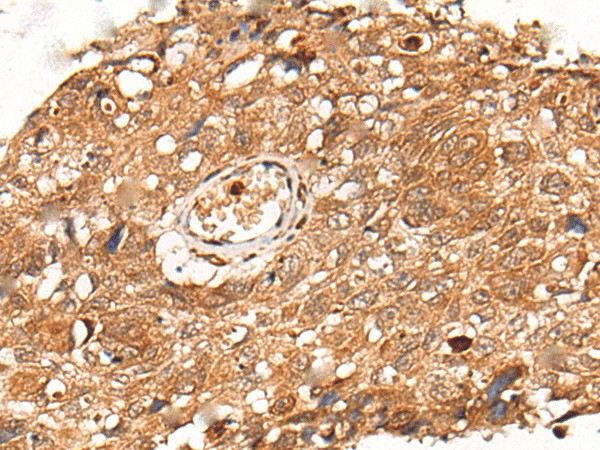 Immunohistochemistry of paraffin-embedded Human lung cancer tissue  using KLHL36 Polyclonal Antibody at dilution of 1:55(?200)