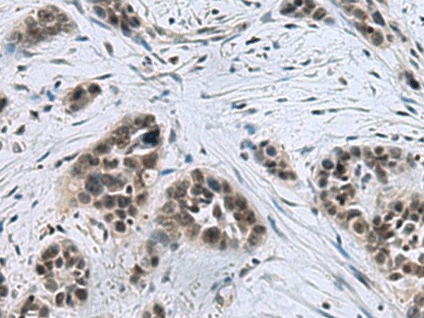 Immunohistochemistry of paraffin-embedded Human thyroid cancer tissue  using CCAR2 Polyclonal Antibody at dilution of 1:40(?200)