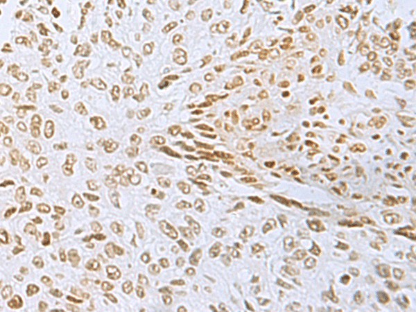 Immunohistochemistry of paraffin-embedded Human lung cancer tissue  using L3MBTL2 Polyclonal Antibody at dilution of 1:60(?200)