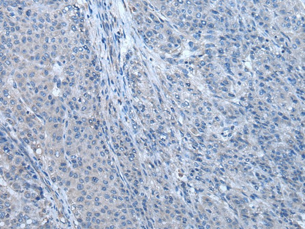 Immunohistochemistry of paraffin-embedded Human liver cancer tissue  using ZBTB3 Polyclonal Antibody at dilution of 1:55(?200)