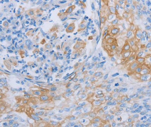 Immunohistochemistry of paraffin-embedded Human cervical cancer tissue using ADRB3 Polyclonal Antibody at dilution 1:60