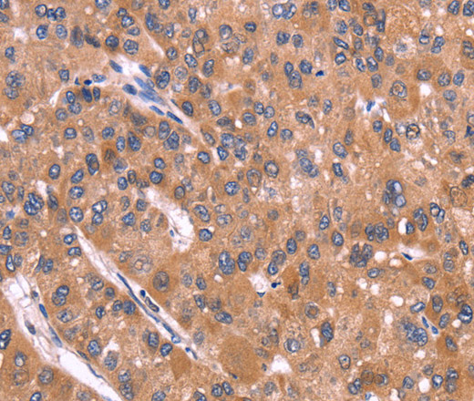 Immunohistochemistry of paraffin-embedded Human liver cancer tissue using CRISP3 Polyclonal Antibody at dilution 1:40