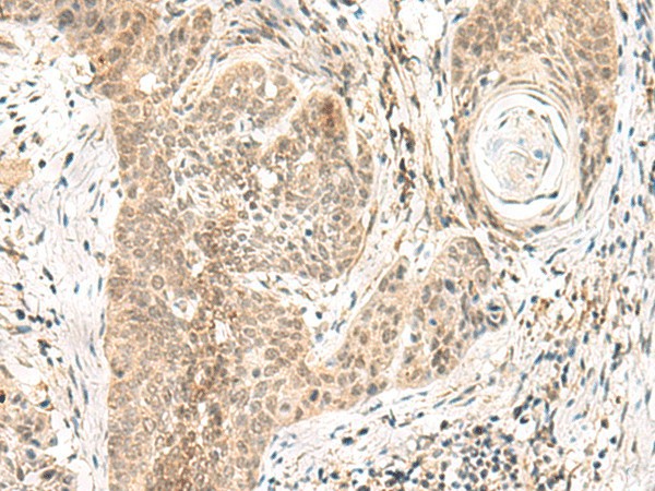 Immunohistochemistry of paraffin-embedded Human esophagus cancer tissue  using GPSM1 Polyclonal Antibody at dilution of 1:55(?200)