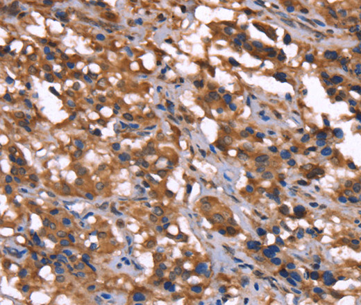 Immunohistochemistry of paraffin-embedded Human thyroid cancer tissue using GREB1 Polyclonal Antibody at dilution 1:40