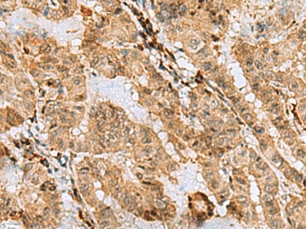 Immunohistochemistry of paraffin-embedded Human thyroid cancer tissue  using ASNA1 Polyclonal Antibody at dilution of 1:70(?200)