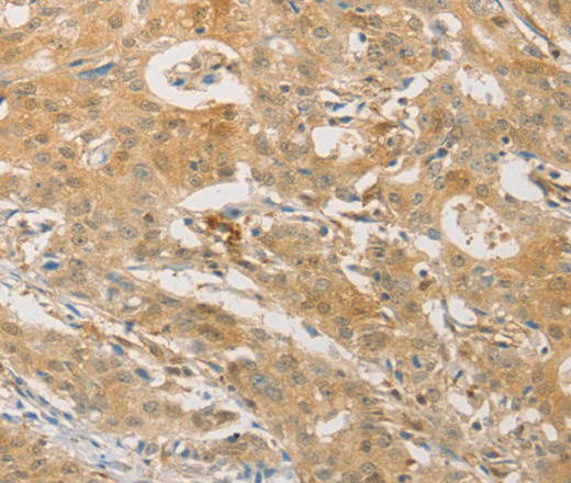 Immunohistochemistry of paraffin-embedded Human gastic cancer using PGK2 Polyclonal Antibody at dilution of 1:50