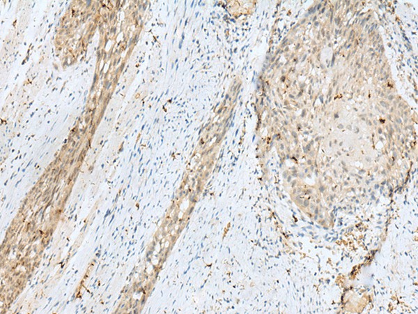 Immunohistochemistry of paraffin-embedded Human esophagus cancer tissue  using TEX11 Polyclonal Antibody at dilution of 1:30(?200)