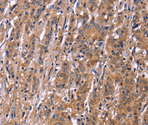 Immunohistochemistry of paraffin-embedded Human gastric cancer using SEPT7 Polyclonal Antibody at dilution of 1:50