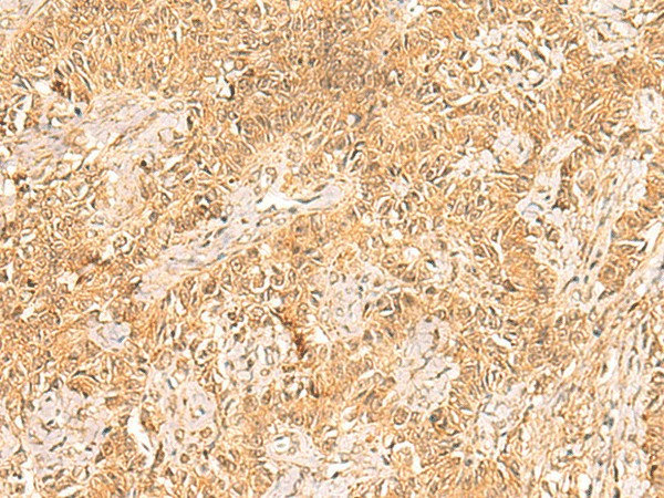 Immunohistochemistry of paraffin-embedded Human ovarian cancer tissue  using TRMT112 Polyclonal Antibody at dilution of 1:30(?200)