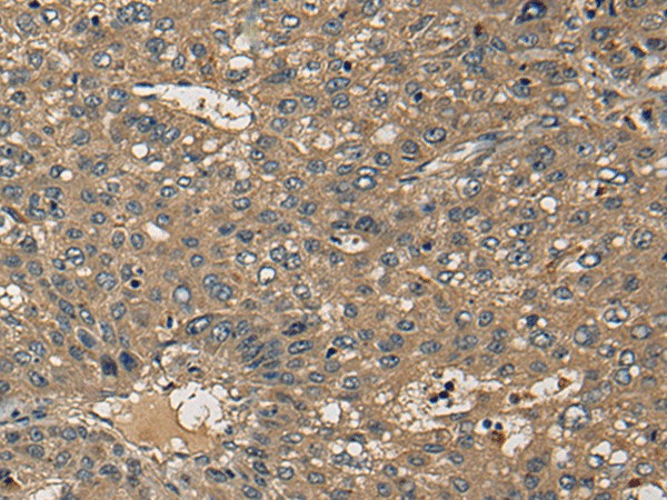 Immunohistochemistry of paraffin-embedded Human liver cancer tissue  using CD1B Polyclonal Antibody at dilution of 1:55(?200)