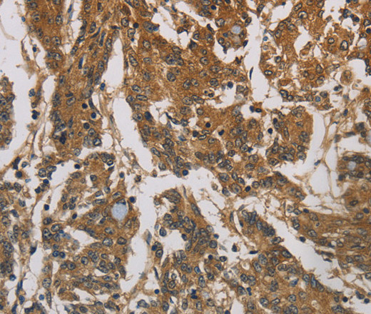 Immunohistochemistry of paraffin-embedded Human colon cancer using CORO1C Polyclonal Antibody at dilution of 1:60