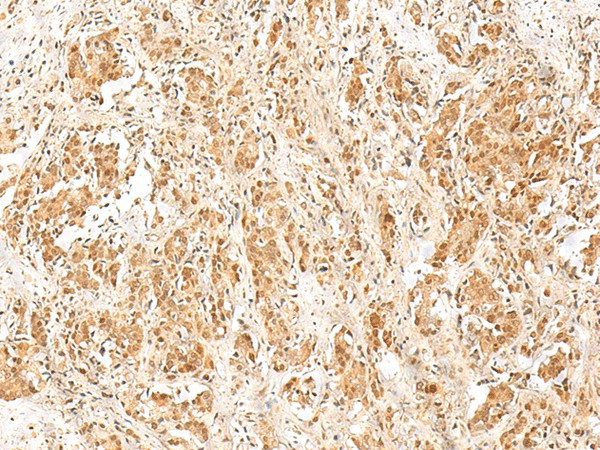 Immunohistochemistry of paraffin-embedded Human prost ate cancer tissue  using RPS27A Polyclonal Antibody at dilution of 1:40(?200)