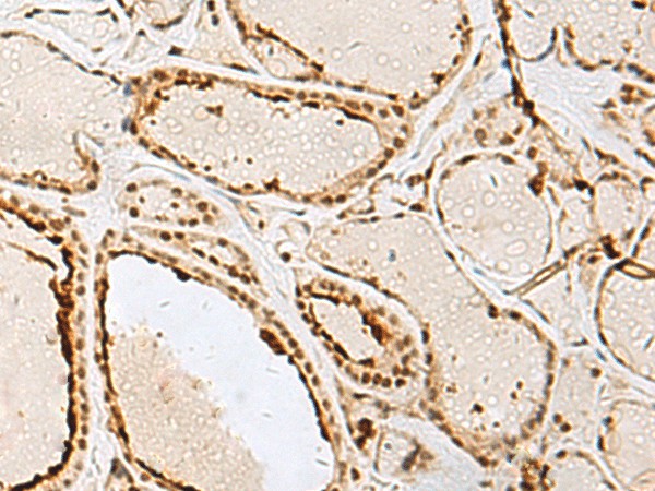 Immunohistochemistry of paraffin-embedded Human thyroid cancer tissue  using IPO11 Polyclonal Antibody at dilution of 1:65(?200)