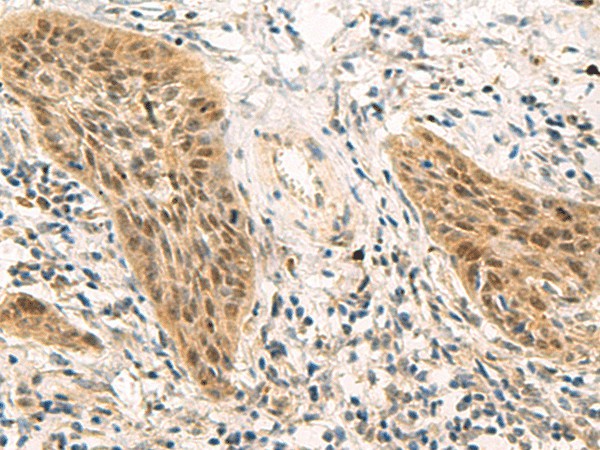 Immunohistochemistry of paraffin-embedded Human esophagus cancer tissue  using PSME1 Polyclonal Antibody at dilution of 1:50(?200)