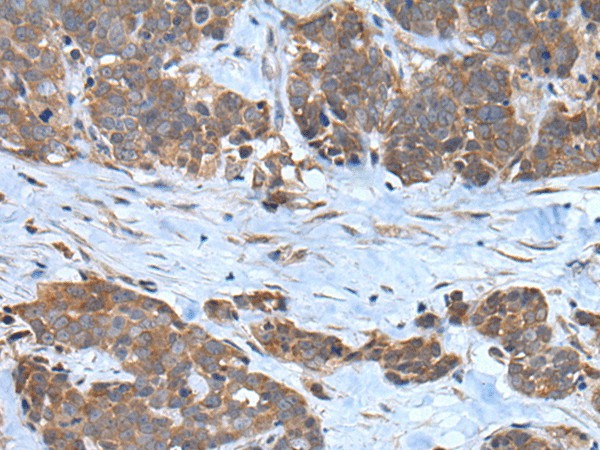 Immunohistochemistry of paraffin-embedded Human thyroid cancer tissue  using CNTN1 Polyclonal Antibody at dilution of 1:35(?200)