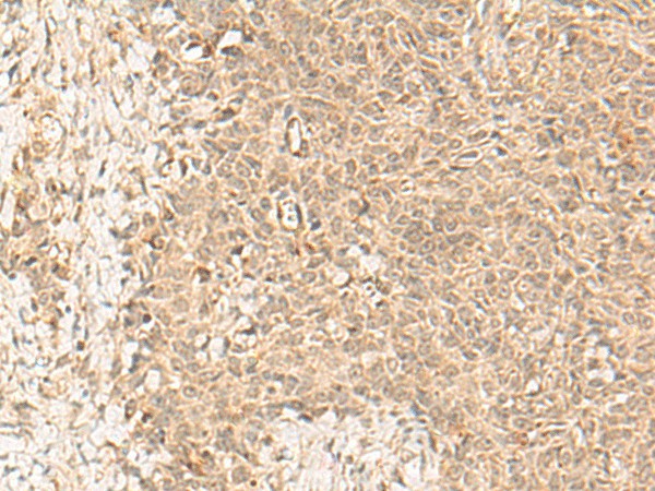 Immunohistochemistry of paraffin-embedded Human ovarian cancer tissue  using FBXL4 Polyclonal Antibody at dilution of 1:25(?200)