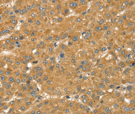 Immunohistochemistry of paraffin-embedded Human liver cancer using SNX2 Polyclonal Antibody at dilution of 1:40