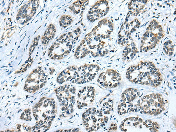 Immunohistochemistry of paraffin-embedded Human esophagus cancer tissue  using GMFB Polyclonal Antibody at dilution of 1:25(?200)