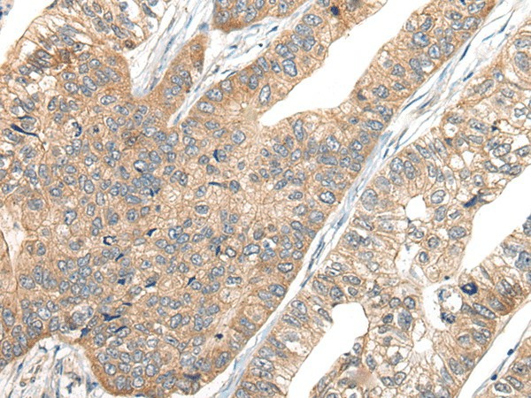 Immunohistochemistry of paraffin-embedded Human gastric cancer tissue  using CA7 Polyclonal Antibody at dilution of 1:50(?200)